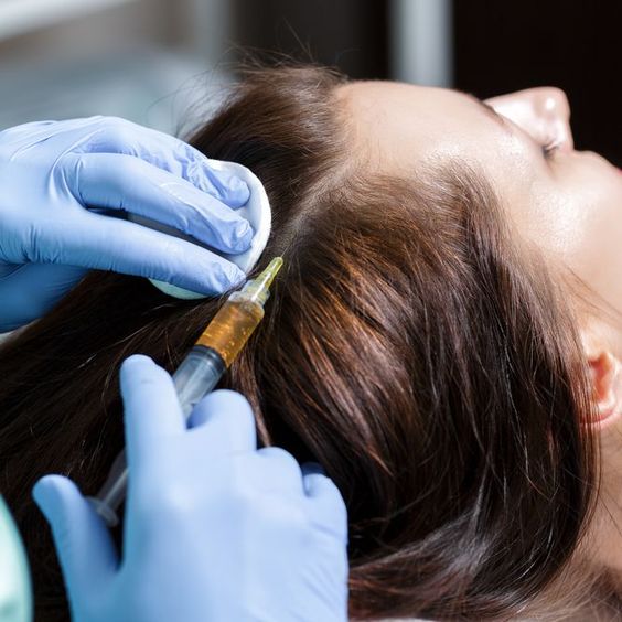 La mesoterapia capilar – Un nuevo y revolucionario tratamiento para la caída del cabello